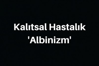 Albinizm (Albino) Hastalığı Nedir ve Neden Olur?