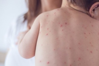 Kızamıkçık (Rubella) hastalığının belirtileri nelerdir? Kızamıkçık nedenleri ve tedavisi