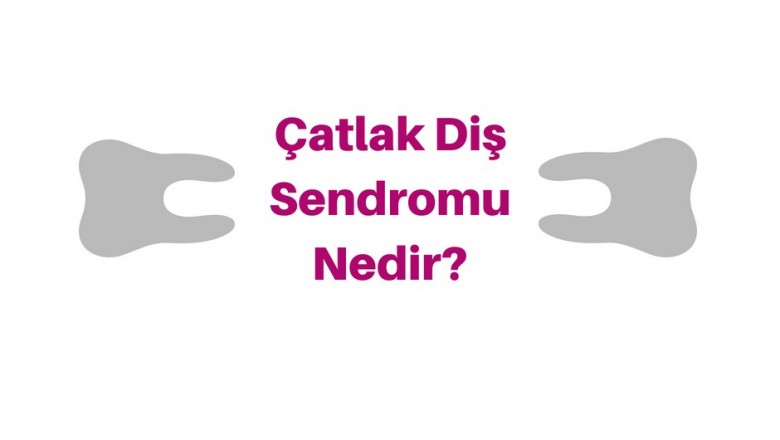 Çatlak Diş Sendromu Nedir? Diş Çatlağı Belirtileri Nedenleri ve Tedavisi