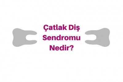 Çatlak Diş Sendromu Nedir? Diş Çatlağı Belirtileri Nedenleri ve Tedavisi