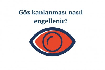 Göz kanlanması neden olur nasıl geçer? Göz kanlanması belirtileri ve tedavisi